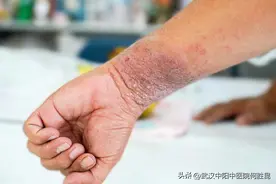 腿上背上身上腰上胳膊上有一块皮肤很厚很硬特别痒越挠越痒咋回事图片