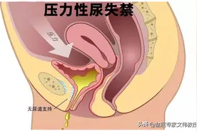 压力性尿失禁的常用手术方式图片