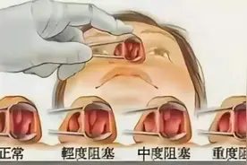 鼻子里面长了个小肉球是怎么回事？图片