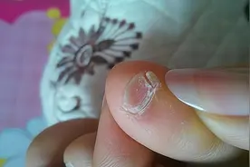 小脚趾指甲被分成两瓣的人，有可能是"纯血汉族人"？这是真的吗？图片