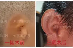 小耳畸形的病因，除遗传因素外，这些因素也可能会导致畸形的发生图片