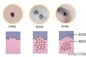 什么是色素痣？有色素痣要不要去除？一篇文章给你讲明白！图片