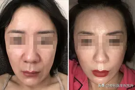 拉皮手术全过程：如果你能熬到第4步，那就要恭喜你了！图片