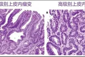 低级别上皮内瘤变是癌吗？图片