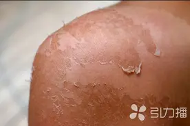 游泳后脱了层皮！苏州医生提醒：这种皮炎严重时可致休克图片