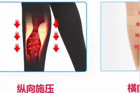 医用弹力袜/静脉曲张袜如何缓解治疗静脉曲张？图片
