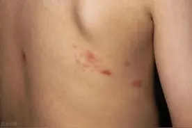 “缠腰龙”带状疱疹剧痛难忍，患者：伴随的神经痛已经持续一年了图片