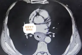 长治二院成功开展一例微创胸腹腔镜联合食管癌根治术图片