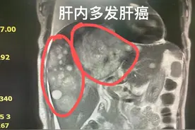 酒量下降，去医院检查到去世只有1个月图片