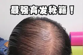 头顶一片光秃秃？过来人教你3招让发量翻倍！抓紧时间做起来！图片