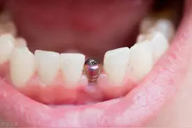 镶牙和种牙有什么区别？图片