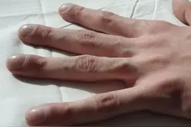 手指出现这些症状，是心脏在向你发出求救！尽早自查图片