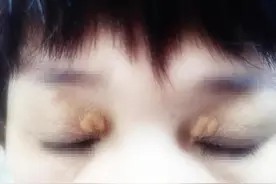 如果区别睑黄瘤和眼周扁平疣？图片