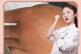 被蜜蜂蛰伤为什么不能直接拔？这样做才是最正确的处理方法！#医学科普 #急救 #涨知识 视频封面