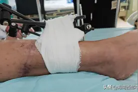 右小腿离断3小时！海南西部中心医院经7个多小时奋战再植保肢成功图片