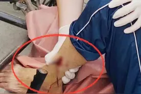 揪心！自行车暗藏“凶器”刺穿老人左腿图片