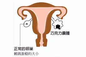 巧克力囊肿怎么解决？为爱美的你推荐巧克力囊肿单孔手术图片