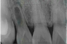 牙齿被细胞逐步“吃掉”？牙内吸收了解一下图片