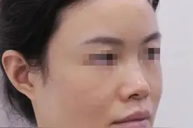 30岁北京姑娘，做完鼻子后“变了一个人”，整个鼻子能改变什么？图片