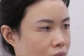 30岁北京姑娘，做完鼻子后“变了一个人”，整个鼻子能改变什么？图片