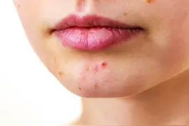 点完痣后皮肤护理如何注意？图片