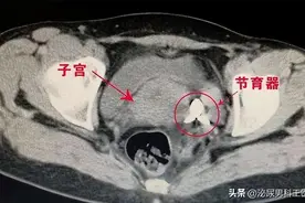 节育环一直不取出来，会长到肉里吗？在多大年龄之前取出比较好？图片