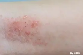 为啥会得湿疹这个讨厌的病？图片