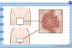 “下面”长了淡红色的小疙瘩，该怎么办？图片