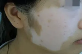 女性白癜风患者的常见问题，你中了几条？图片