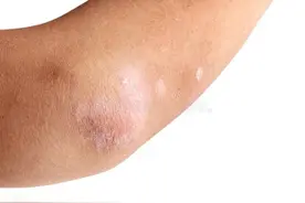 银屑病有哪些原因？图片