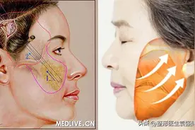 拉皮手术后一定会“回落”，听医生说明其中真相图片