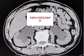 两小时手术彻底解决困扰爹爹3年多的排尿困难及起夜问题图片