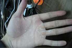 一到换季时，手脚就开始脱皮是怎么回事？是生病还是缺营养了？图片