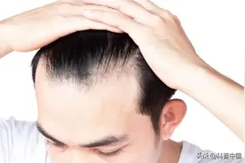 这种“生发神器”会有“狂脱期”？！用前必须了解5个问题图片