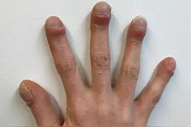 手指变粗，竟然是肺癌？医生提醒：手指末端角度，别超过180°图片