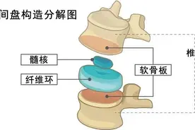 什么是颈椎间盘突出？图片