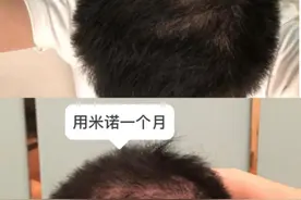 “米诺地尔是智商税，用完可能变秃子！”来看看这位发友亲身经历图片