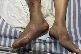好危险！湖南男子被“烂肉王”咬伤！土蛇医划开伤口致流血不止图片