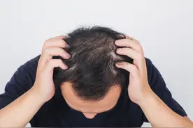 “米诺”治脱发，为什么有些人不管用？多年脱发还有救吗？图片