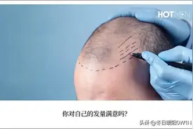 不植发、不用药，如何实现发量逆袭？图片