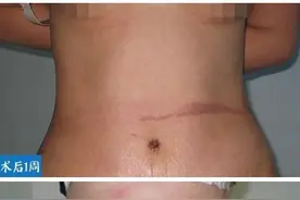 产后腹部松弛，身材走样，还能恢复如初吗？图片