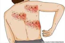 带状疱疹神经痛后遗症中医处方图片
