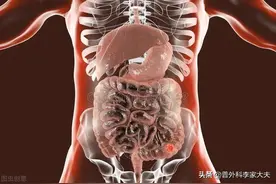 那些活过5年、10年、20年的肠癌患者，都有哪些特征？图片