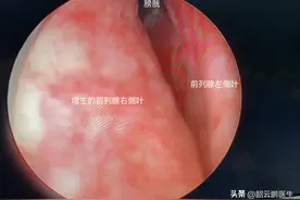 前列腺增生治还是不治？别着急说不，先了解这五大常见误区图片