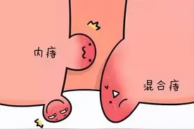 外痔肉球不要怕，农村有一宝克制它图片