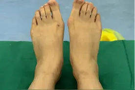 “人家是工作突出，我是大脚骨突出”拇外翻没必要做手术？图片