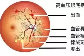 高血压眼底病变了解清楚即可远离图片