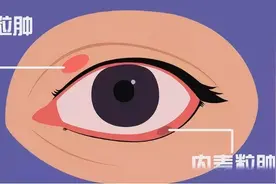眼睛长“针眼”，是因为看了羞羞的东西？这答案我也是没想到图片