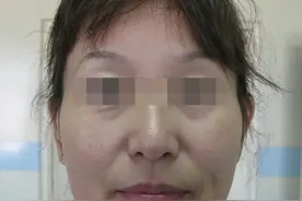 整形医生说：面部除皱这3种方法还不错图片