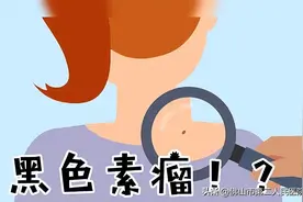 37岁歌手因患黑色素瘤去世，有这些痣的朋友要当心！图片